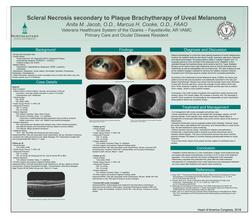Scleral Necrosis secondary to Plaque Brachytherapy of Uveal Melanoma